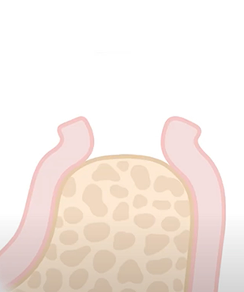 Implantat Schritt 1