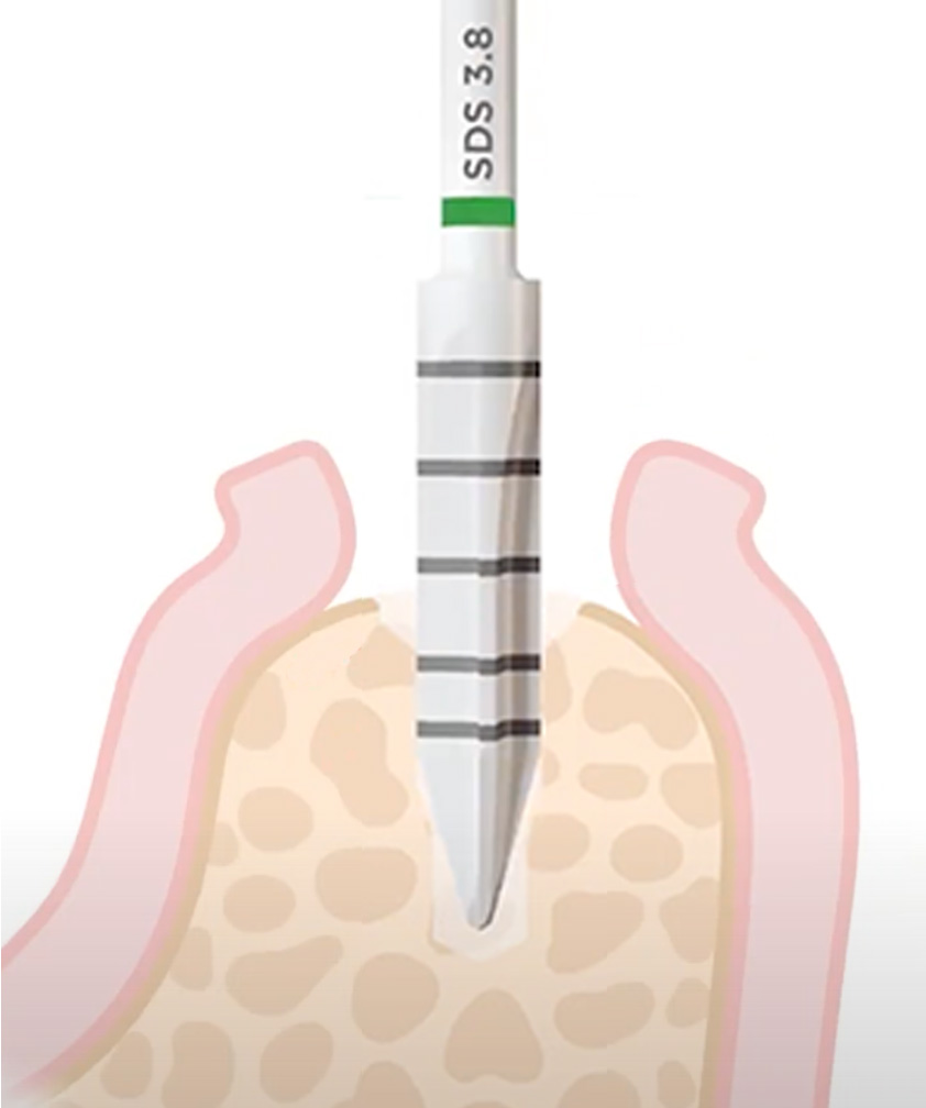 Implantat Schritt 2